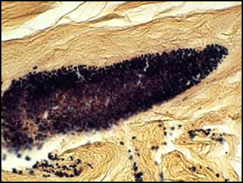 Gram-stained diabetic foot ulcer tissue